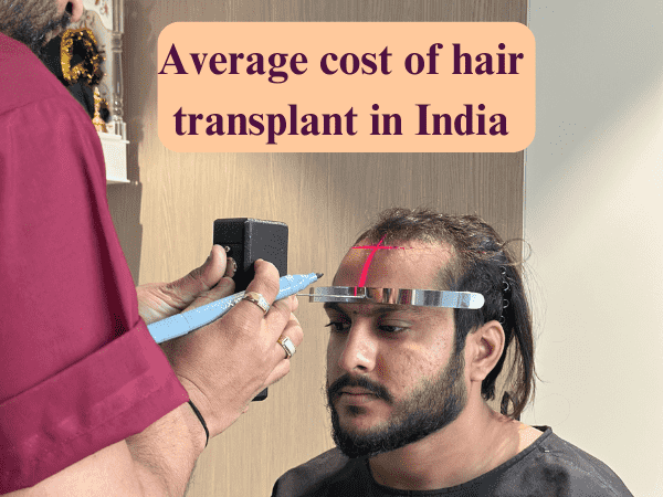 average cost of hair transplant in india